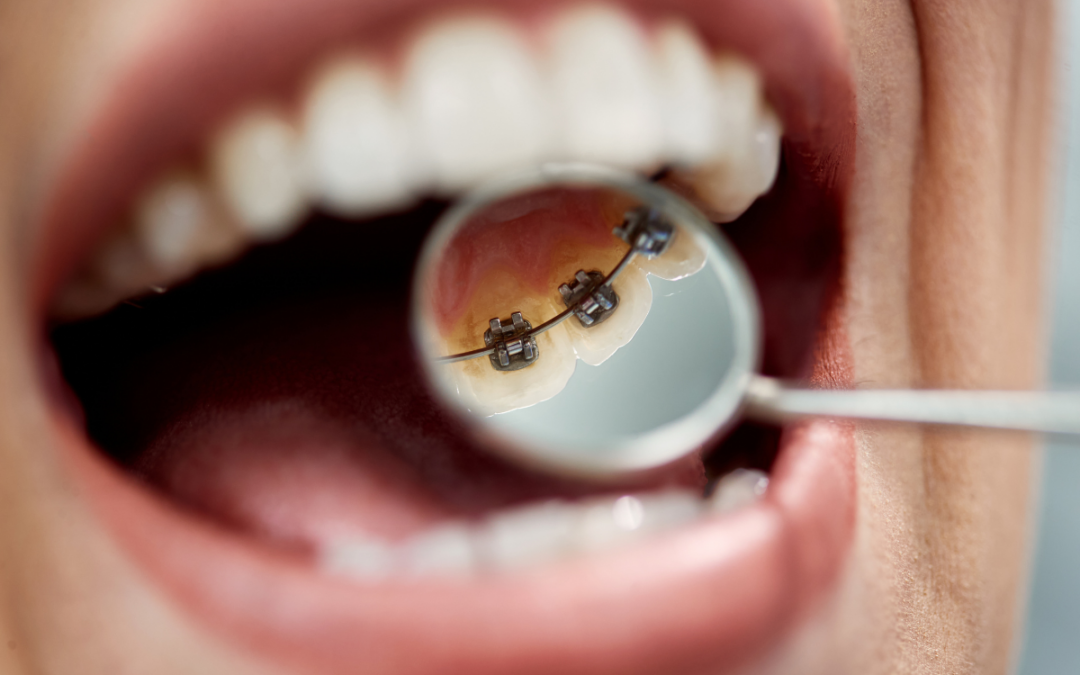 Are Lingual Braces Effective for Complex Orthodontic Cases?