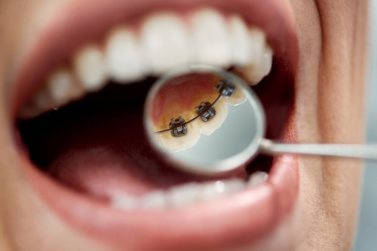 Effectiveness of Lingual Braces for Complex Orthodontic Cases Can Lingual Braces Treat Orthodontic Concerns?